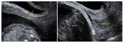 cesarean scar scar thickness measurement ultrasound|cesarean section scar measurement.